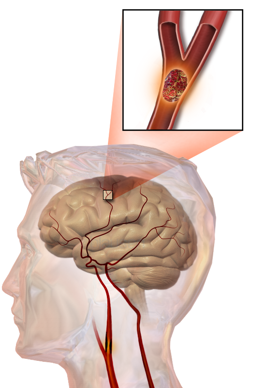 AVC causé par une thrombose