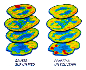 TEP activité du cerveau